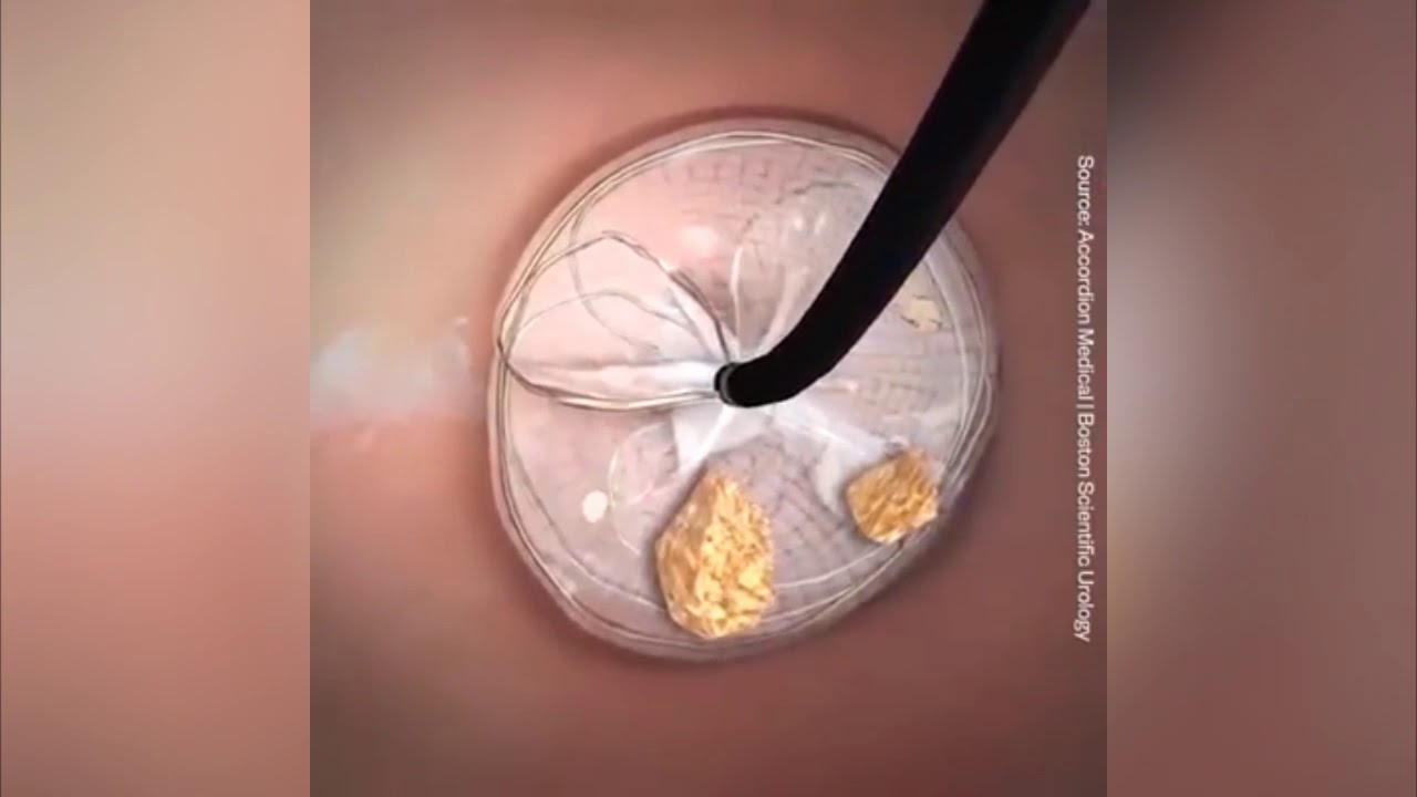 Kidney stone removal