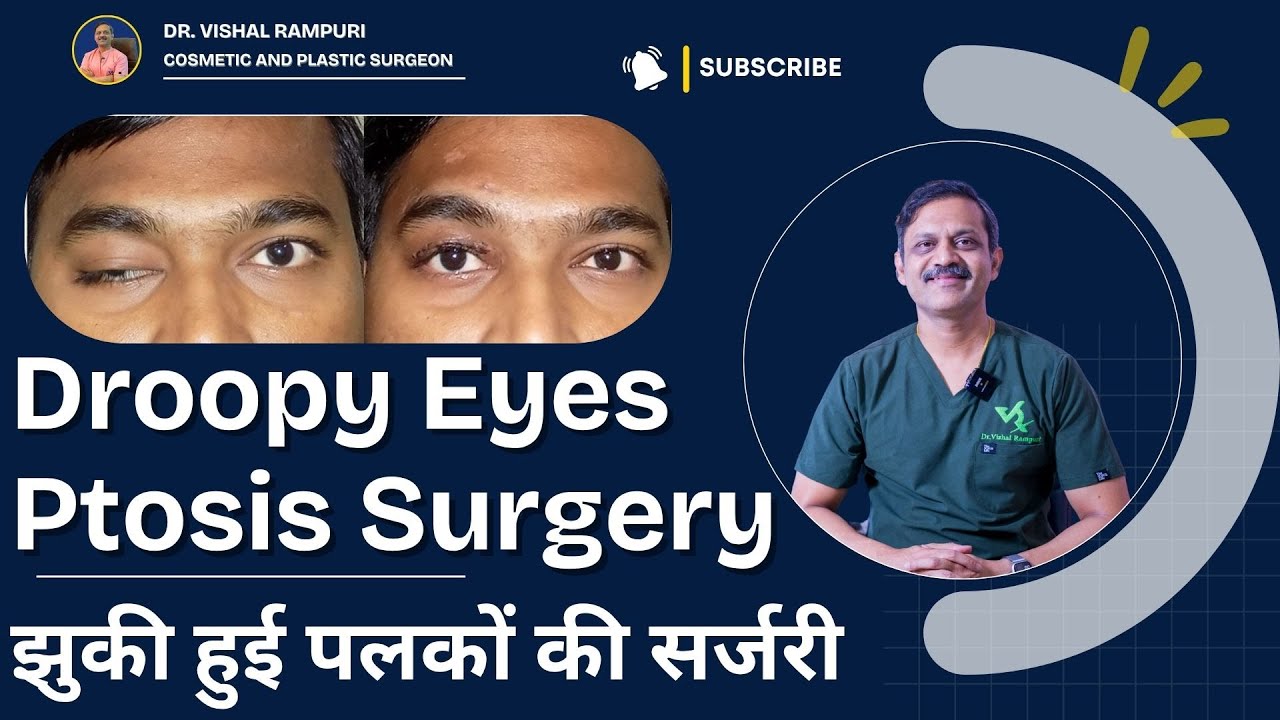 झुकी हुई पलकों (Ptosis) की सर्जरी कब और कैसे होती है | Droopy Eyes Ptosis Surgery Cost