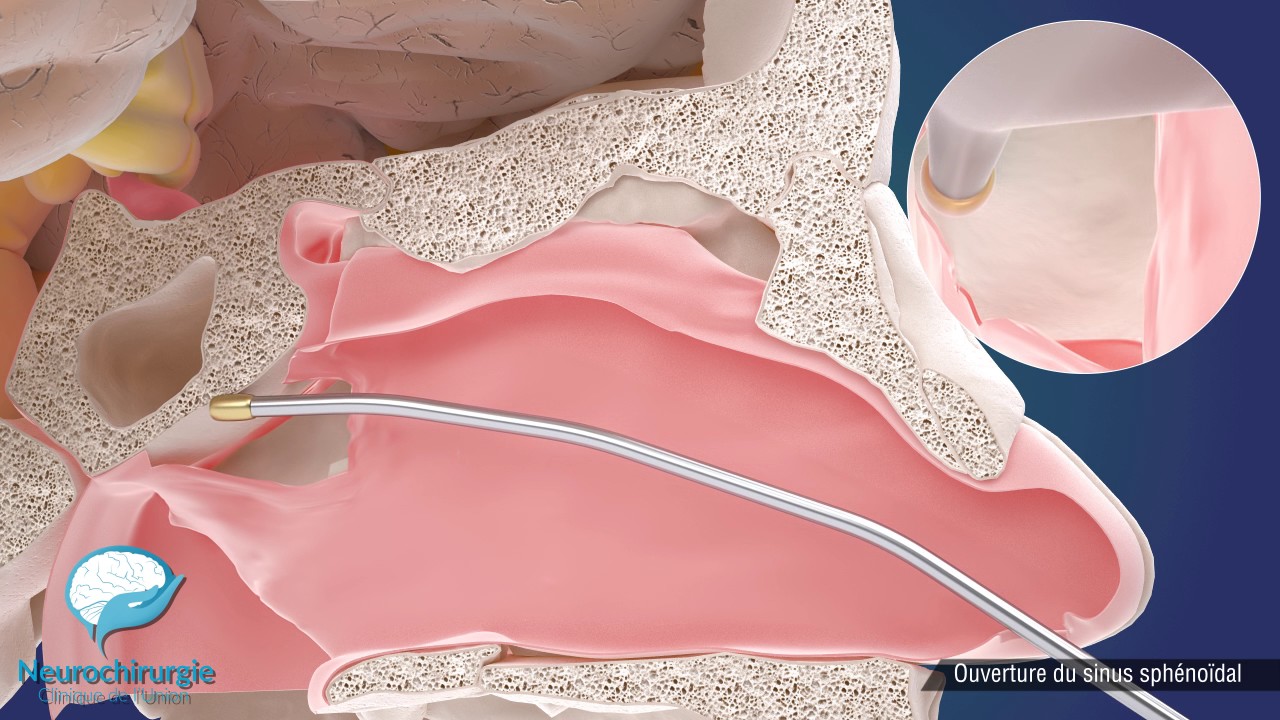 Chirurgie Hypophysaire Endoscopique