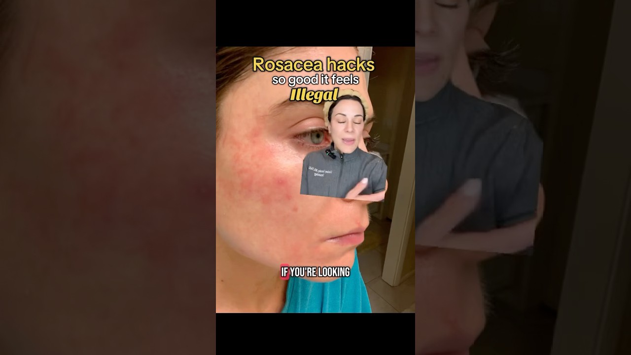Rosacea HACKS So Good It Feels Illegal &mdash; From A Derm | #shorts #skincare |