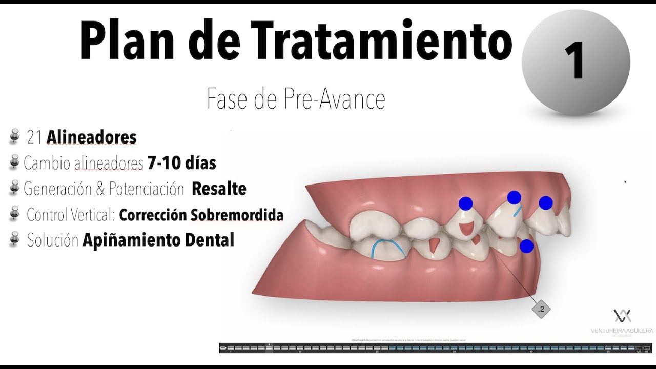 Protocolos y Fases de Tratamiento de Avance Mandibular Invisalign: a propósito de un caso
