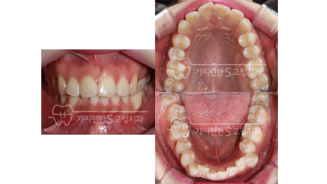 총생과 돌출입과 과개교합, 한번에 없애는 과정 ㅣ 김포 교정