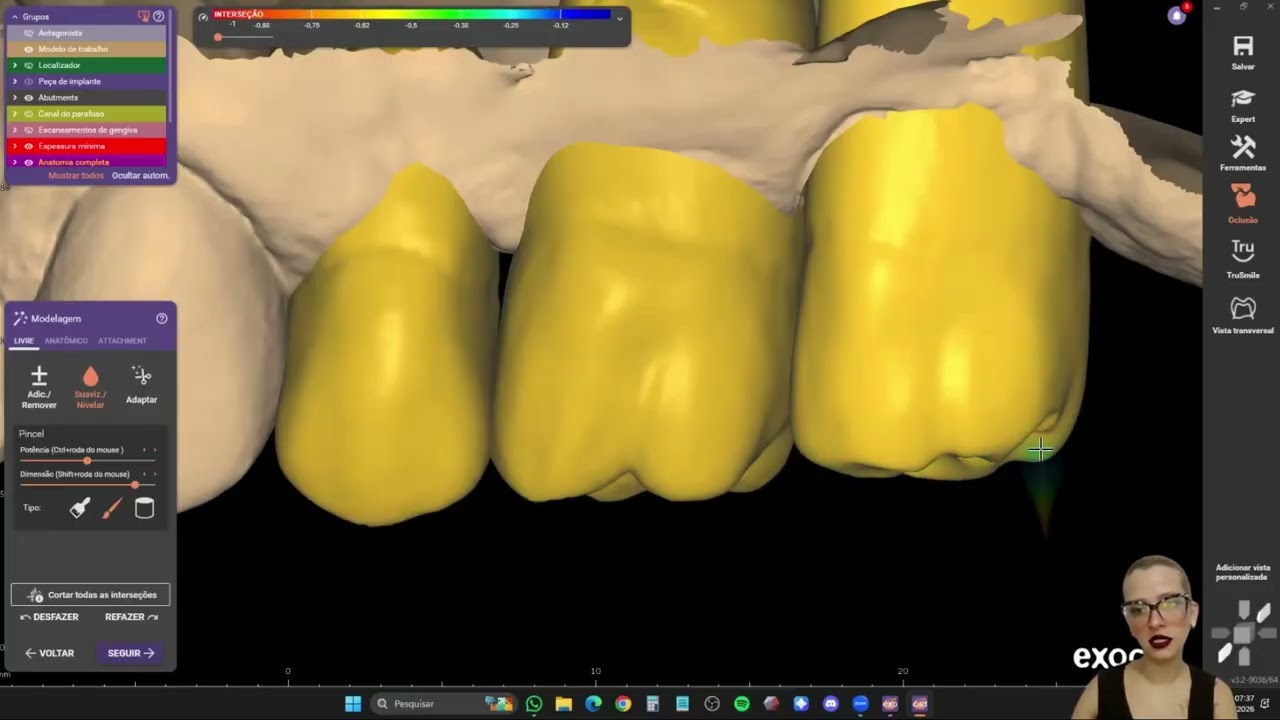 10° vídeo da série: 31 dias x 31 vídeos sobre exocad - Uma Fixa sobre Implantes