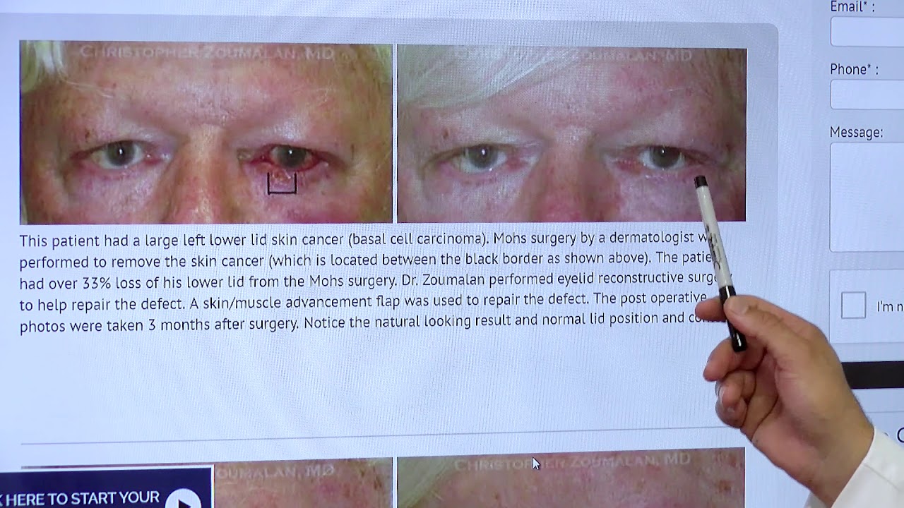 Treating Eyelid Skin Cancer