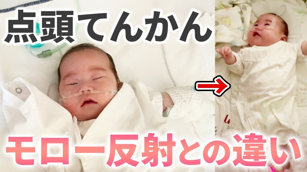 点頭てんかんの様子【ウエスト症候群】
