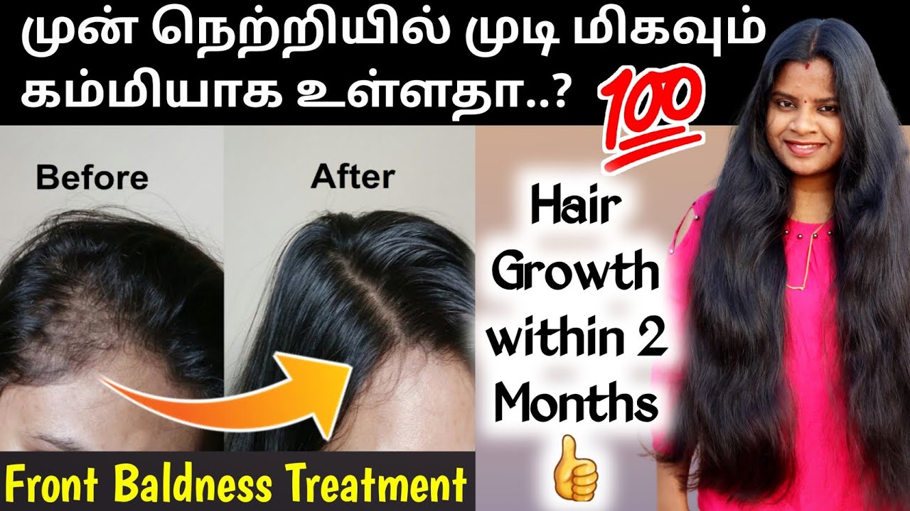 😍Just 2 months🤩முன் நெற்றியில் முடி வளர..! Best Front Baldness Treatment at home @Jegatheesmeena