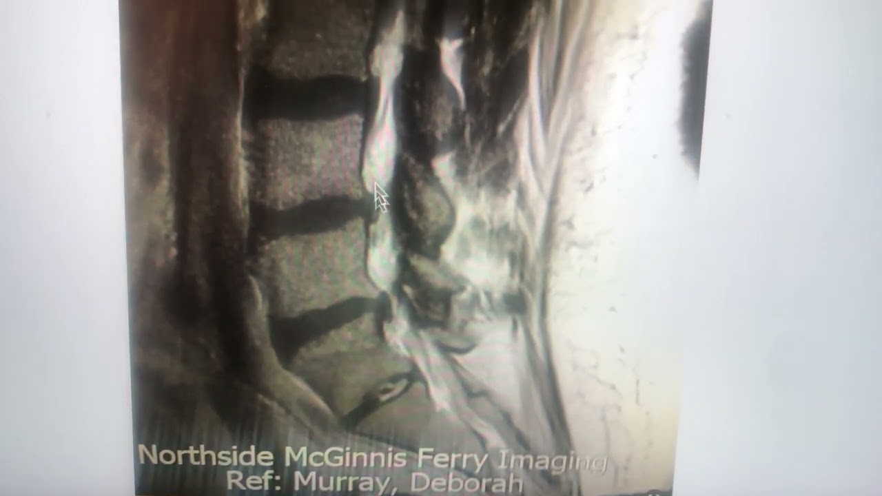 Disc resorption in the lumbar spine