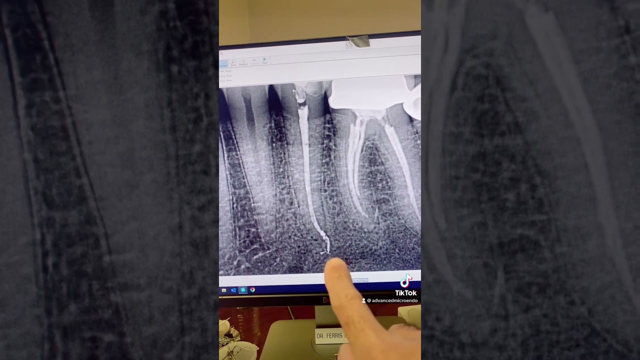Sealer extrusion! Oh no! 3 years recall on tooth #20.