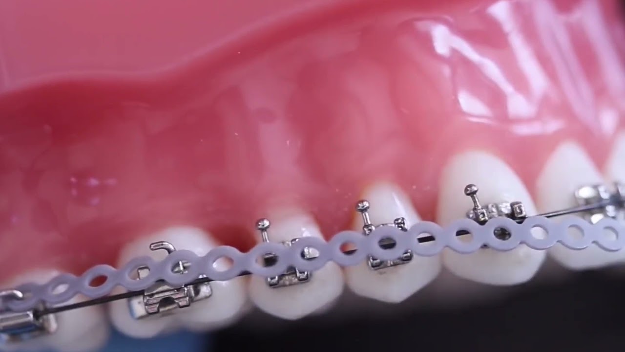 Cara Pemakaian Power Chain Pada perawatan Orthodonti