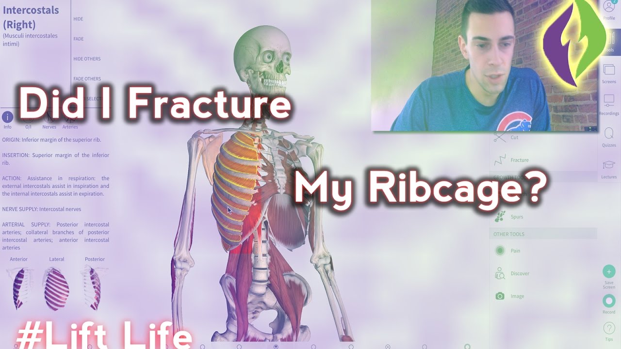 Intercostal Muscle Strain Injury   My Hypothesis and Area Anatomy