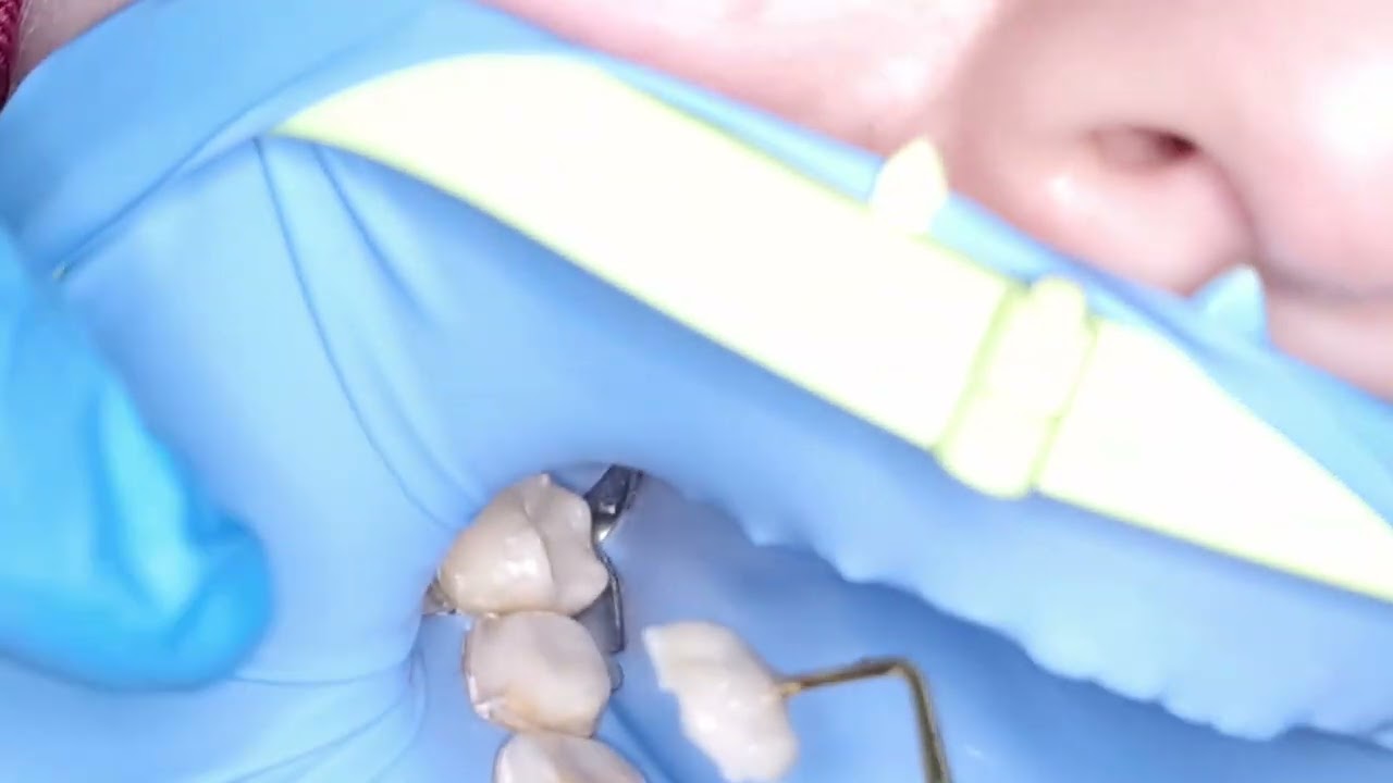 overlay cementation ...