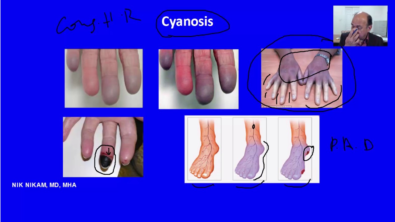 What causes Cyanosis by NIK NIKAM MD
