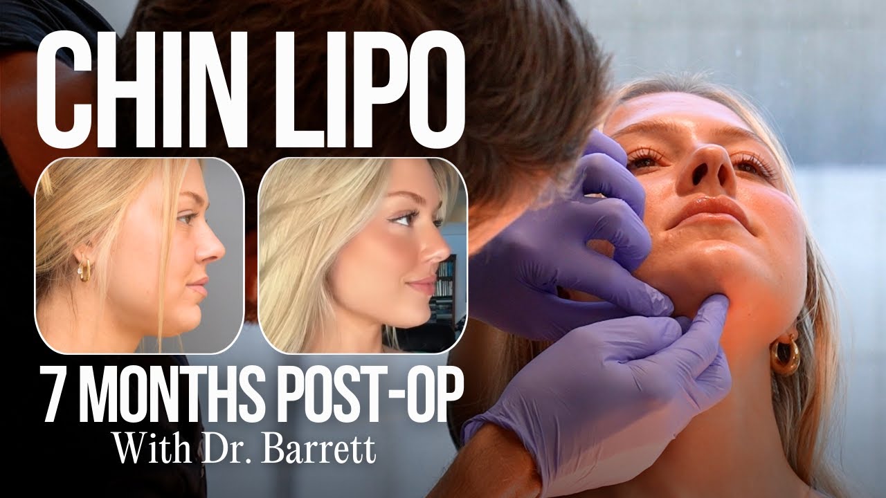 How Chin Lipo Sculpted This Jawline!
