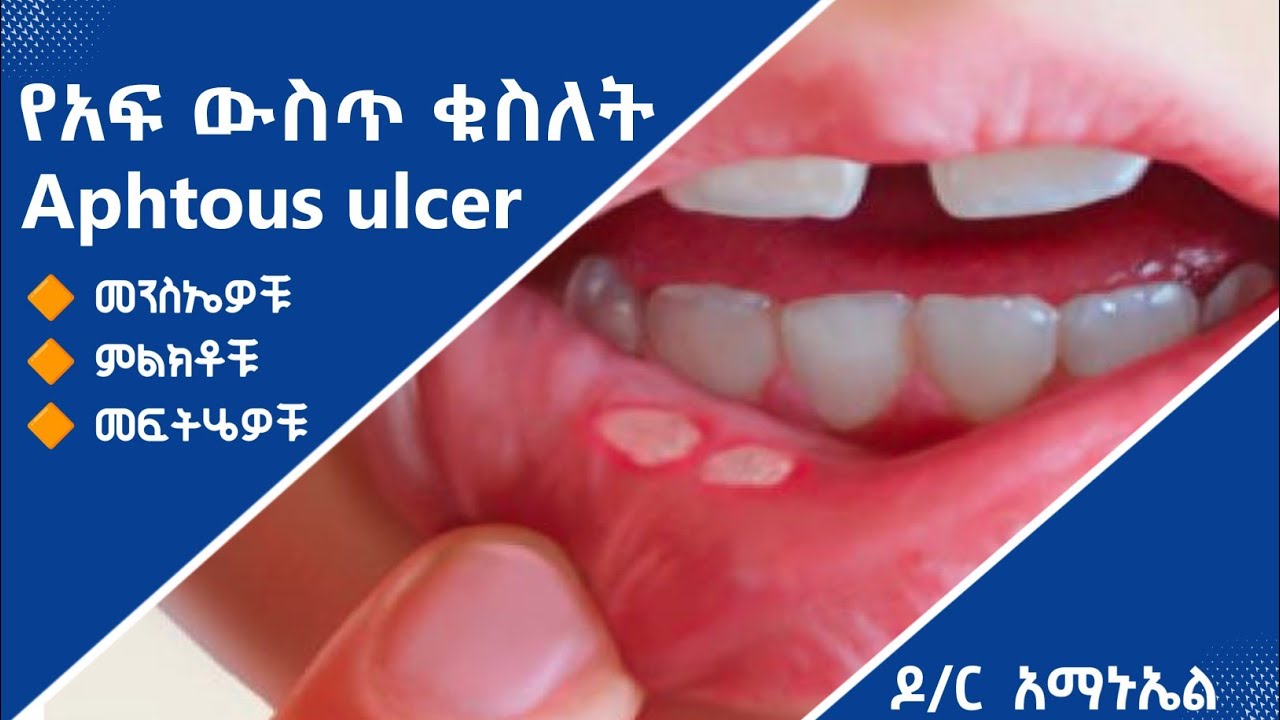 🔴 የአፍ ውስጥ ቁስለት (Aphtous ulcer ) መንስኤዎቹ ፣ ምልክቶቹ እና መፍትሄው