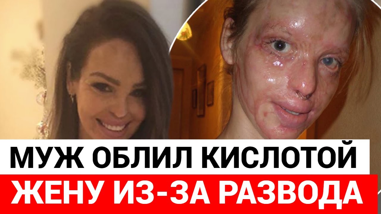 Муж облил жену серной кислотой по пути в ЗАГС за разводом