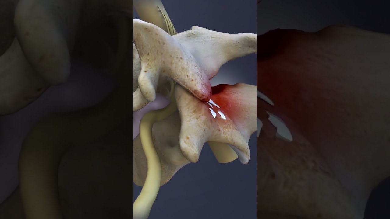 Spinal Conditions of the C6-C7 Spinal Motion Segment