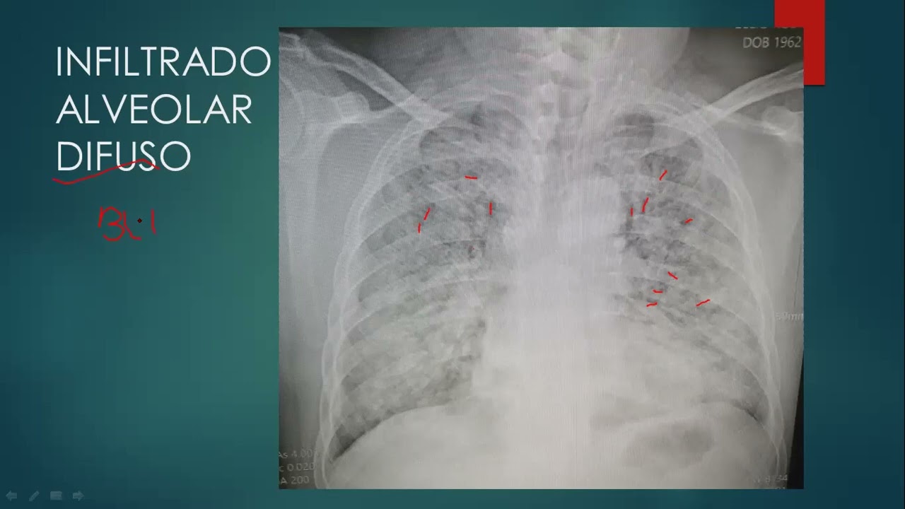 INFILTRADOS PULMONARES EN RX DE TORAX-DRA. NURIA GONZALEZ DUVERGE