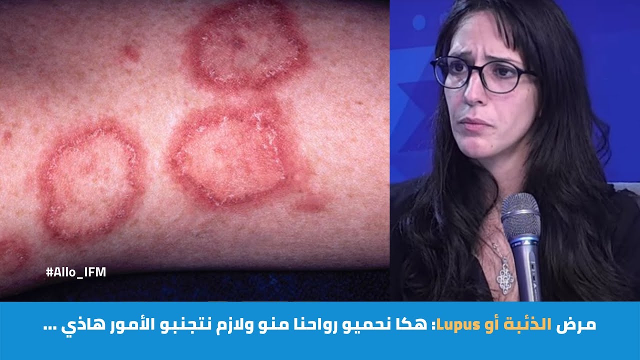 مرض الذئبة أو Lupus: هكا نحميو رواحنا منو ولازم نتجنبو الأمور هاذي ...