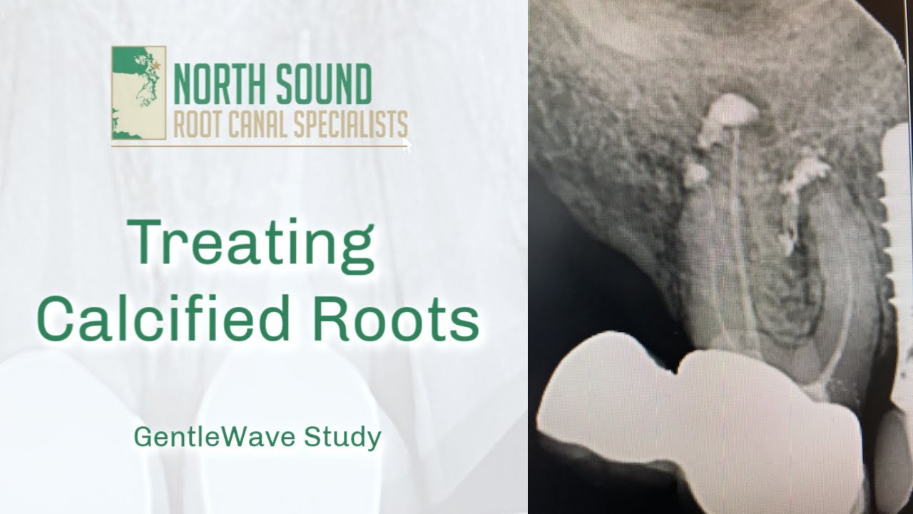 Root Canal Treatment on a Calcified Tooth- GentleWave&reg;