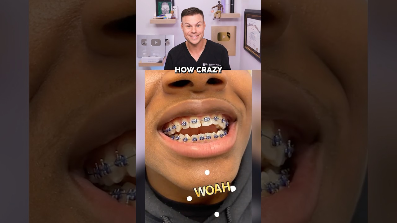 Is This The FASTEST Way To Get Braces?! 😮🦷