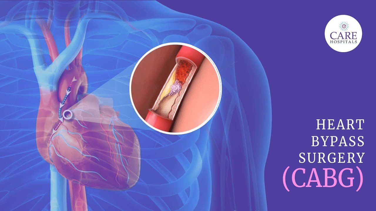 How is Coronary Artery Bypass Graft (CABG) Surgery Done? | Heart Bypass Surgery