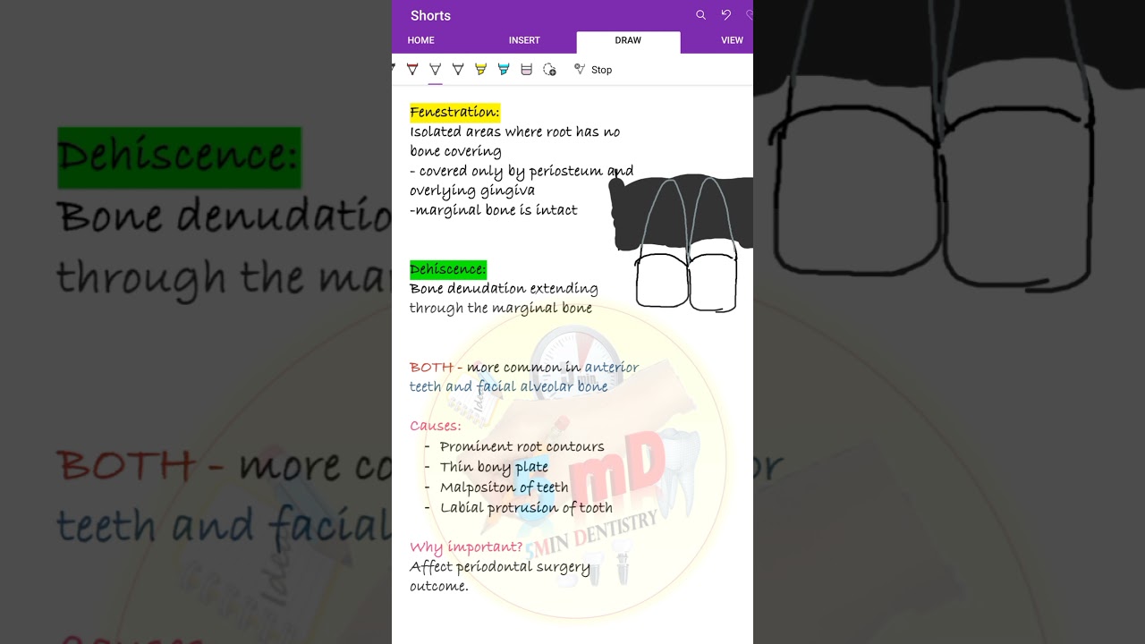 Fenestration and Dehiscence  
