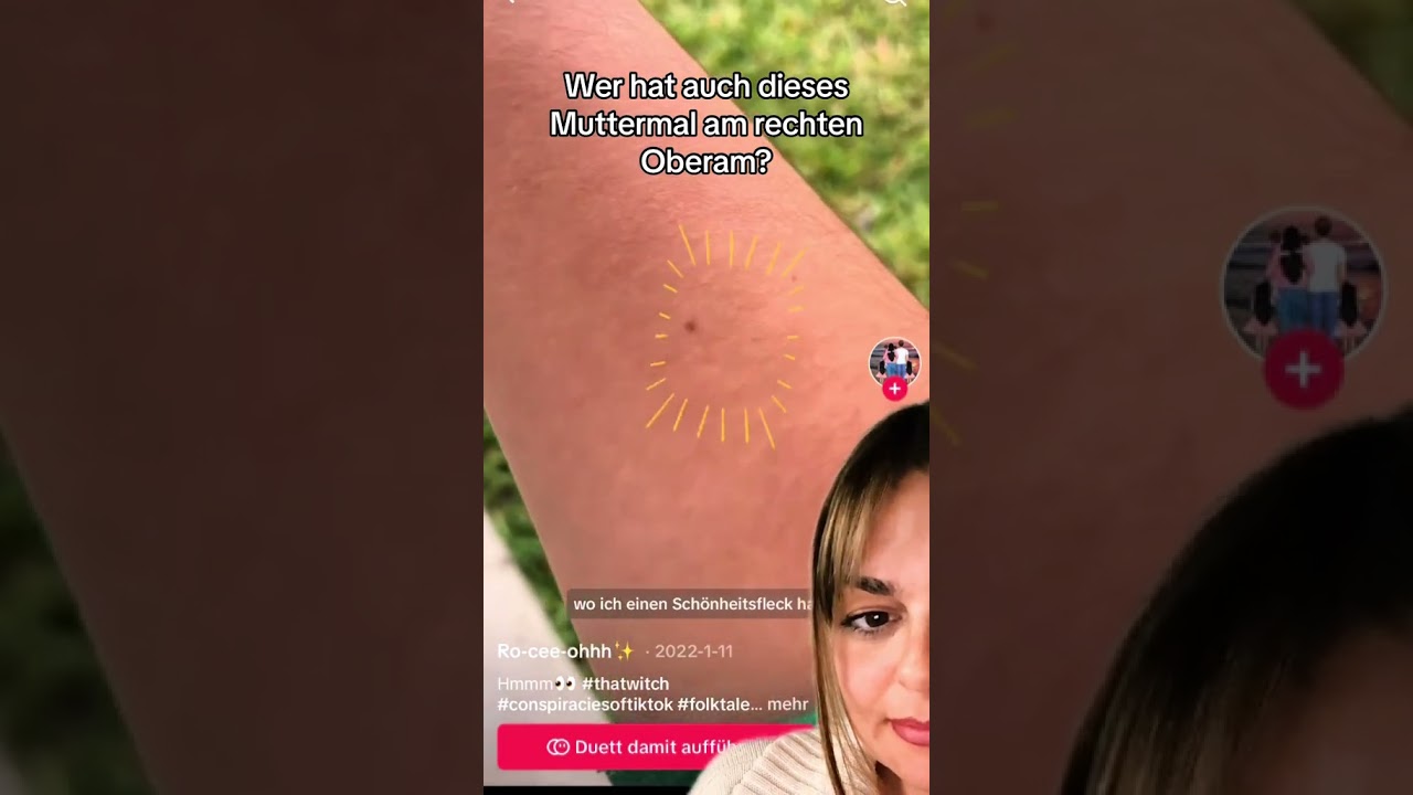 Muttermal am rechten Unterarm?