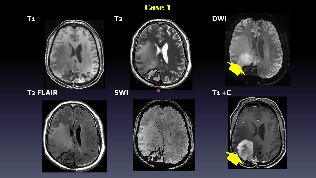 ISMRM MR Academy: 7T ASL Perfusion MRI - Methods and Applications
