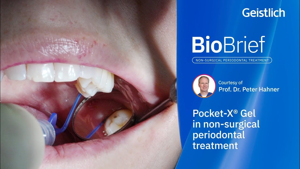 Pocket-X&reg; Gel for Non-Surgical Periodontal Treatment | Case Study by Prof. Dr. Peter Hahner