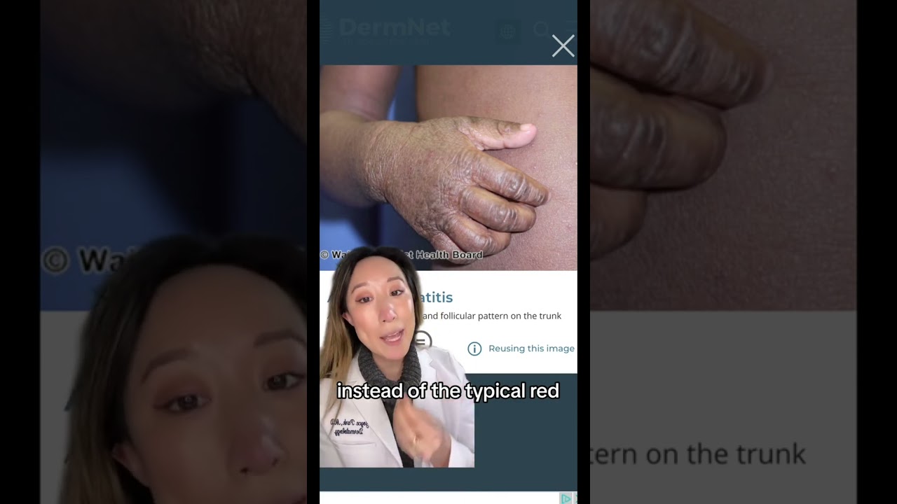 Let&rsquo;s talk about #eczema : what it is, why you get it!