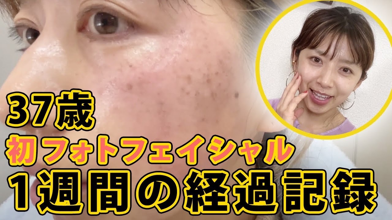 【シミ、そばかす治療】37歳主婦フォトフェイシャル初体験【アラフォー】