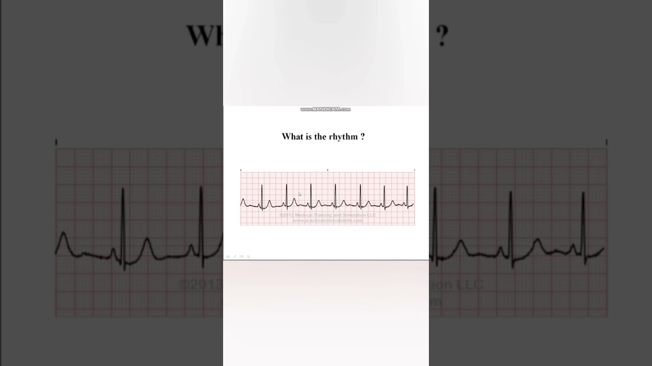 إزاي تحدد ال Rhythm  Regular / Irregular