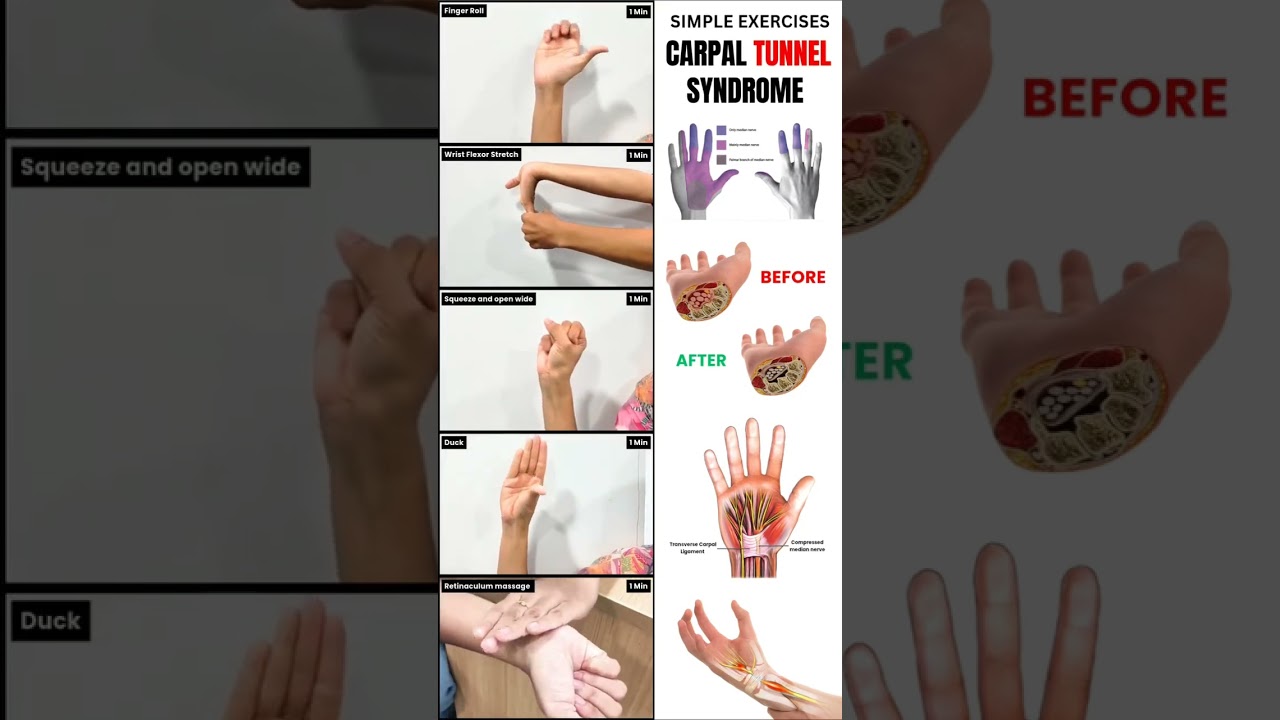 ✨ 5 Easy Exercises for Carpal Tunnel Relief 🖐️ | Physiotherapist-Approved ✅
