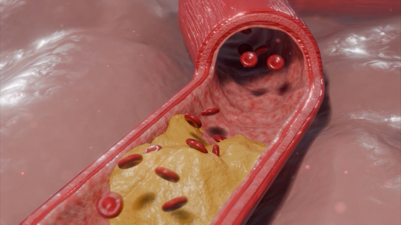 TidalHealth Explains the Advancements in Treating Peripheral Artery Disease