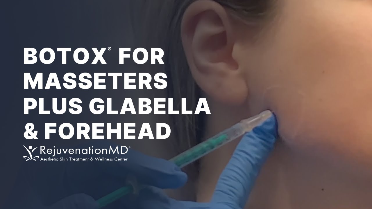Botox for Masseters: Alleviate Teeth Clenching, TMJ, and Grinding