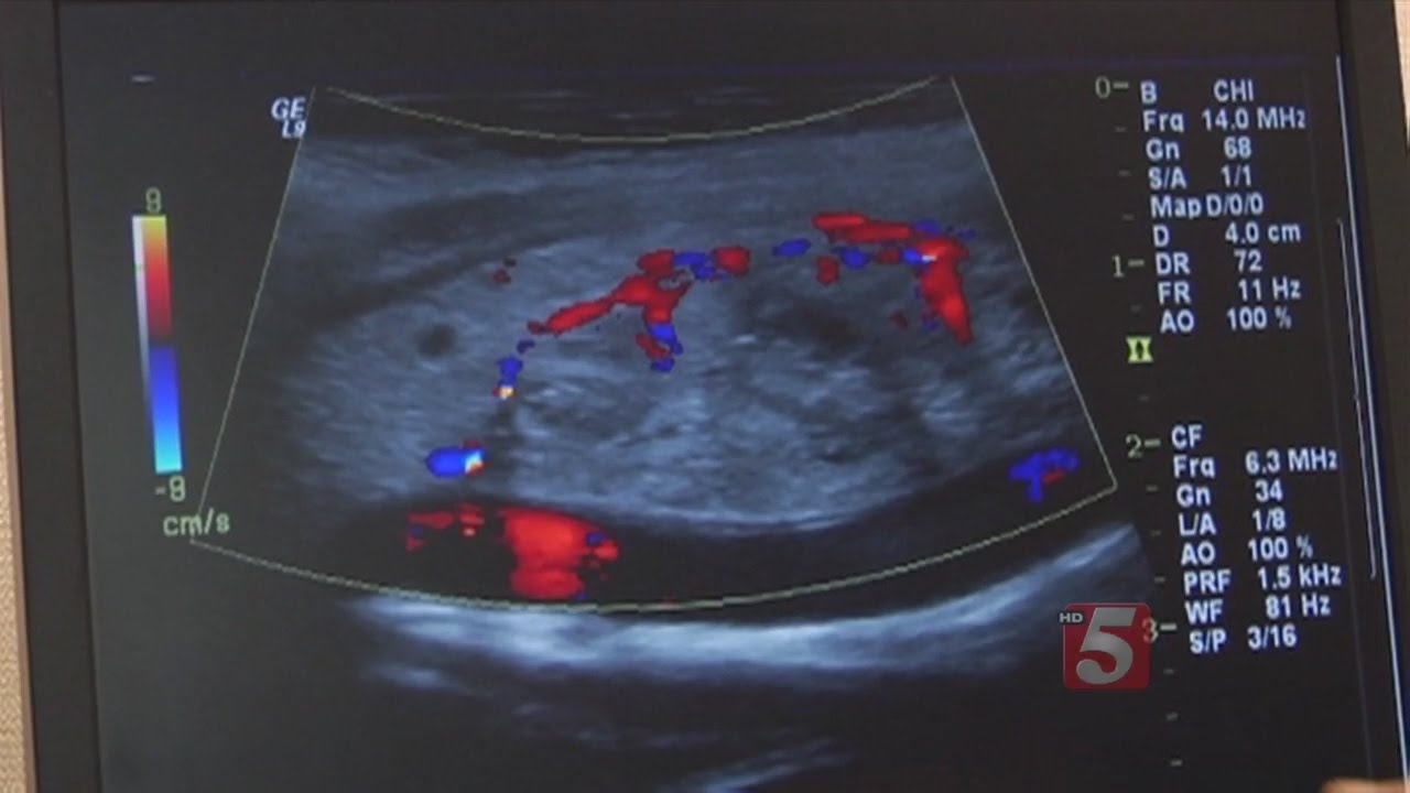 New Test To Diagnose Thyroid Cancer