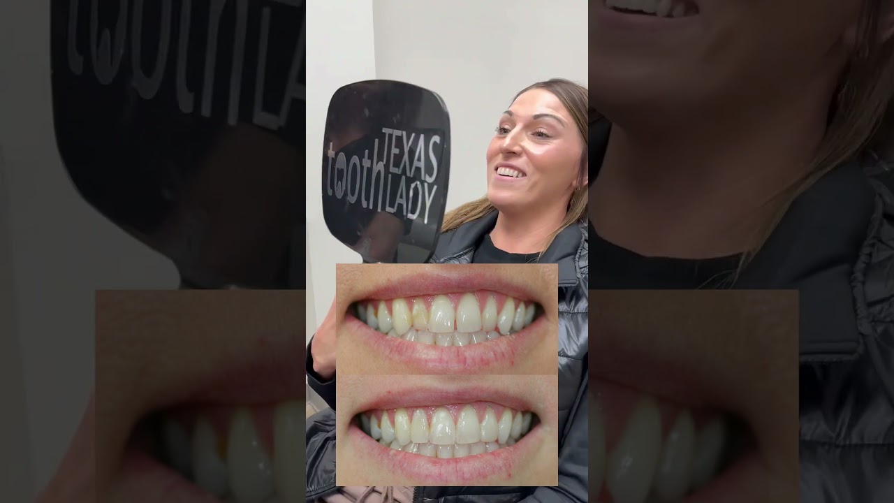 One hour composite bonding on 4 front teeth . Affordable option to porcelain veneers