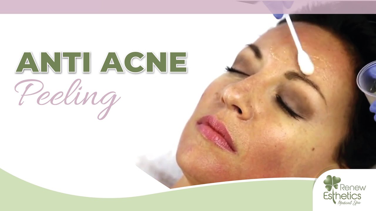 Anti Acne Peeling treatment    Renew Esthetics Medical Spa   Queens NY