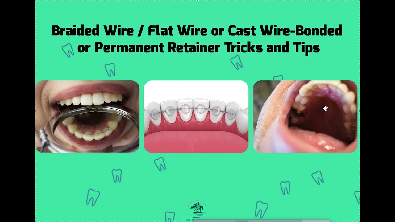 Bonded or Fixed Retainers: Braided Wire vs Ribbon vs Stainless