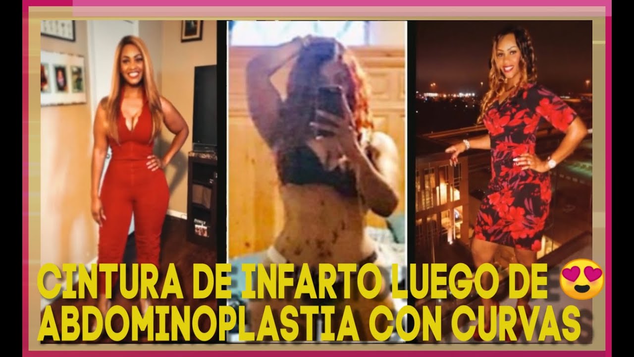 Impresionante Resultado de Abdominoplastia | Dr.Cortes #1 Houston TX