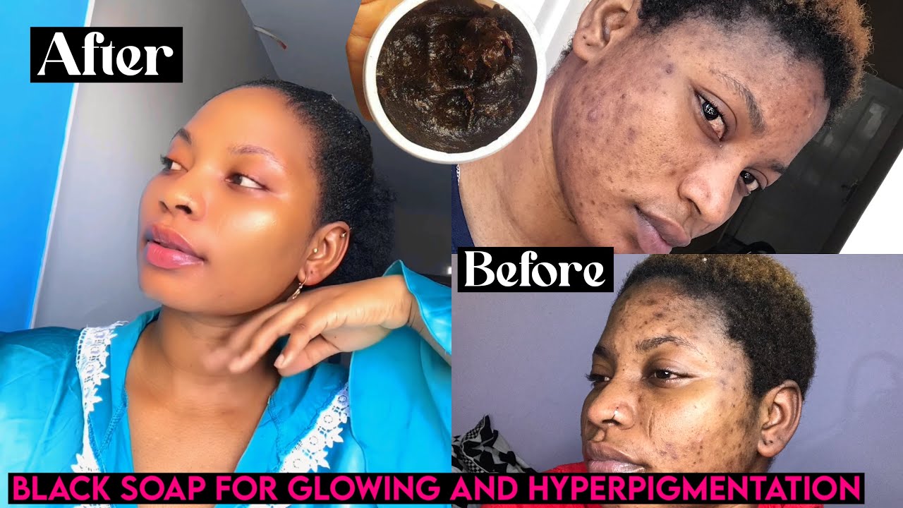 HOW TO MIX AFRICAN BLACK SOAP FOR FAST GLOWING SKIN AND HYPERPIGMENTATION |diy black soap