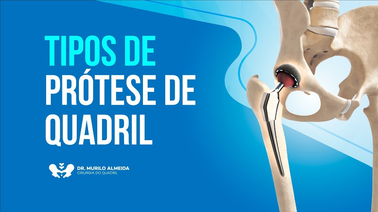 Tipo de próteses de Quadril | Dr. Murilo Almeida
