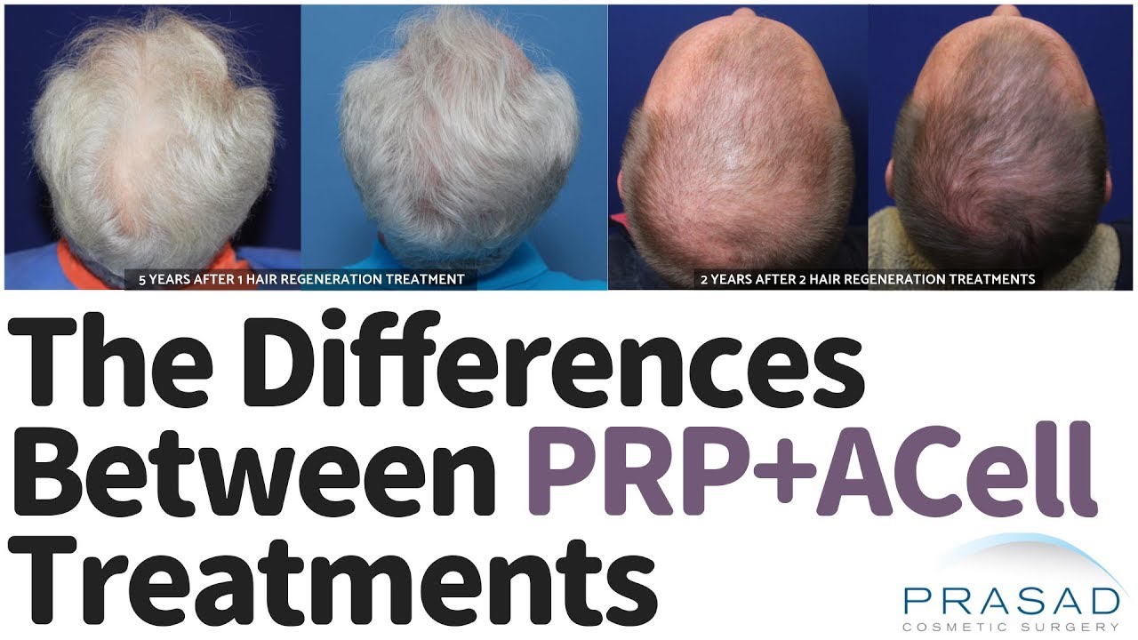Why Various PRP+ACell Treatments for Hair Loss are Not Equally Effective