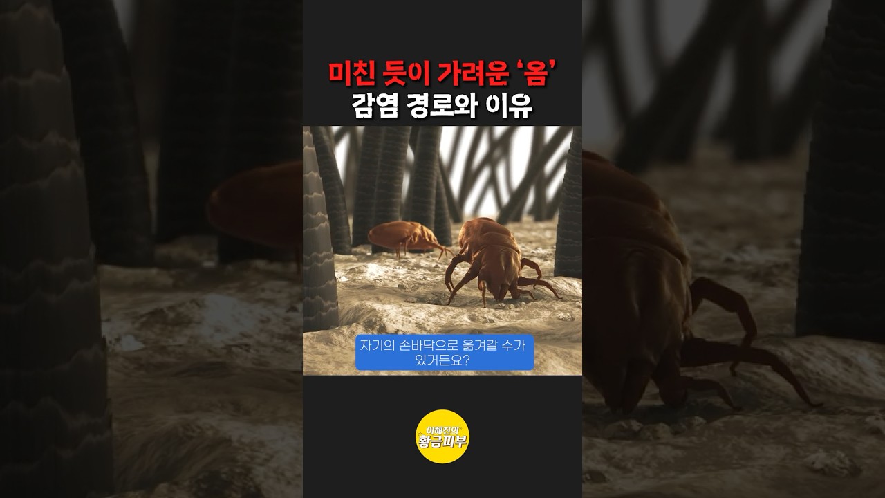 미친 듯이 가려운 '옴'의 감염 경로와 이유