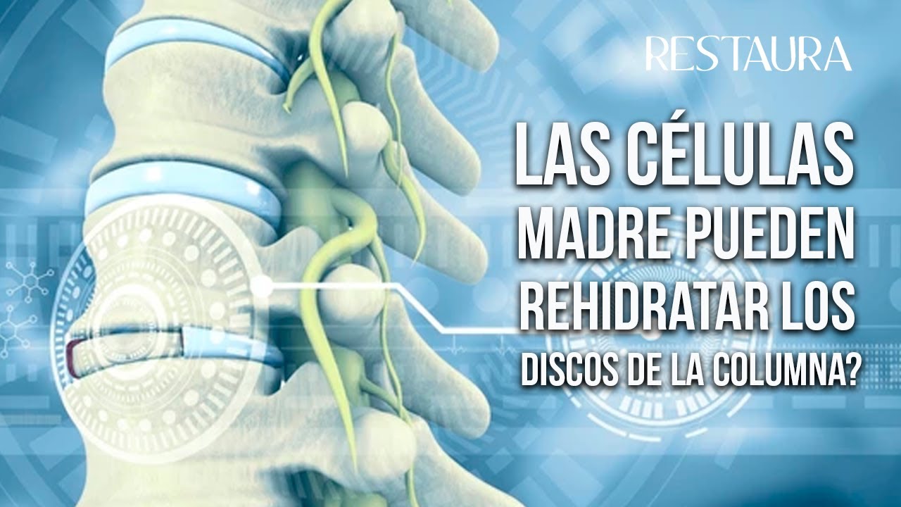 ¿Las células madre pueden rehidratar los discos de la columna?