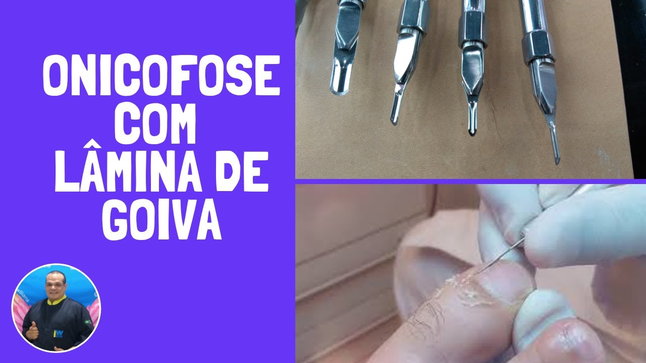Como desencravar unha sem dor - Retirada de calo do sulco (Parte 5)