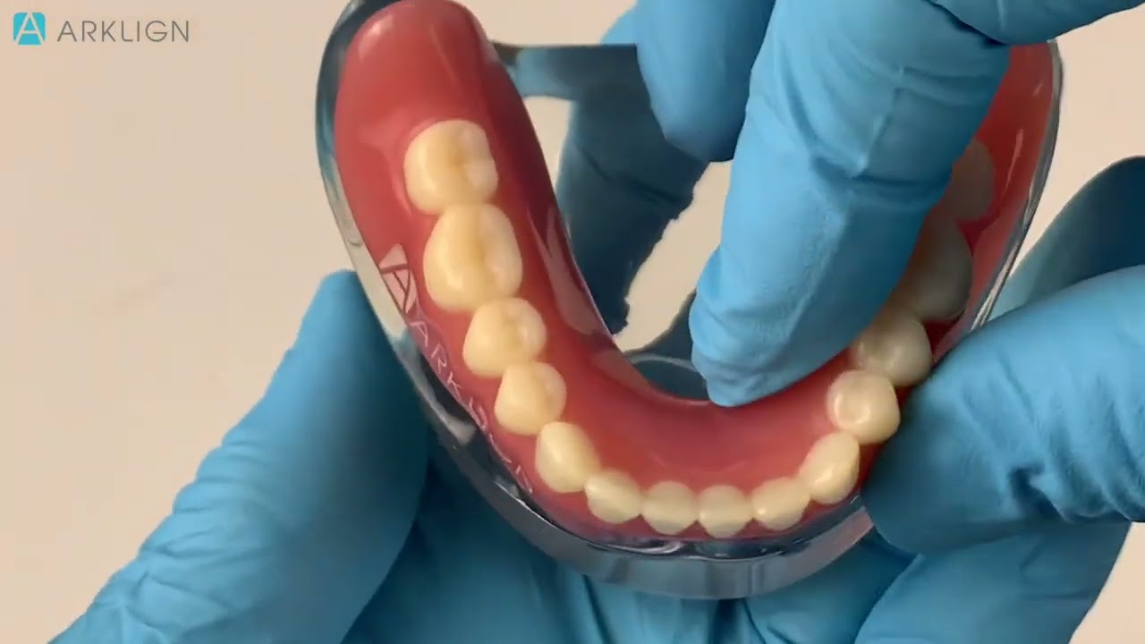Secret sauce to making a great LOCATOR Overdenture @ZestDentalSolutions @arklign8978 ​⁠