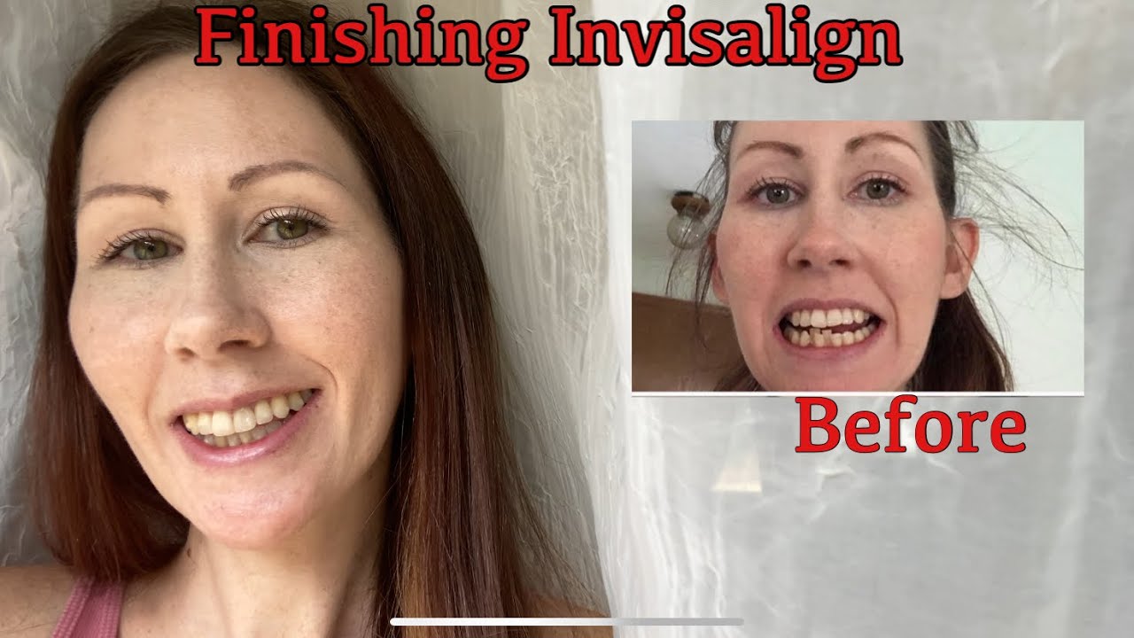 Invisalign update - Before & After result photos