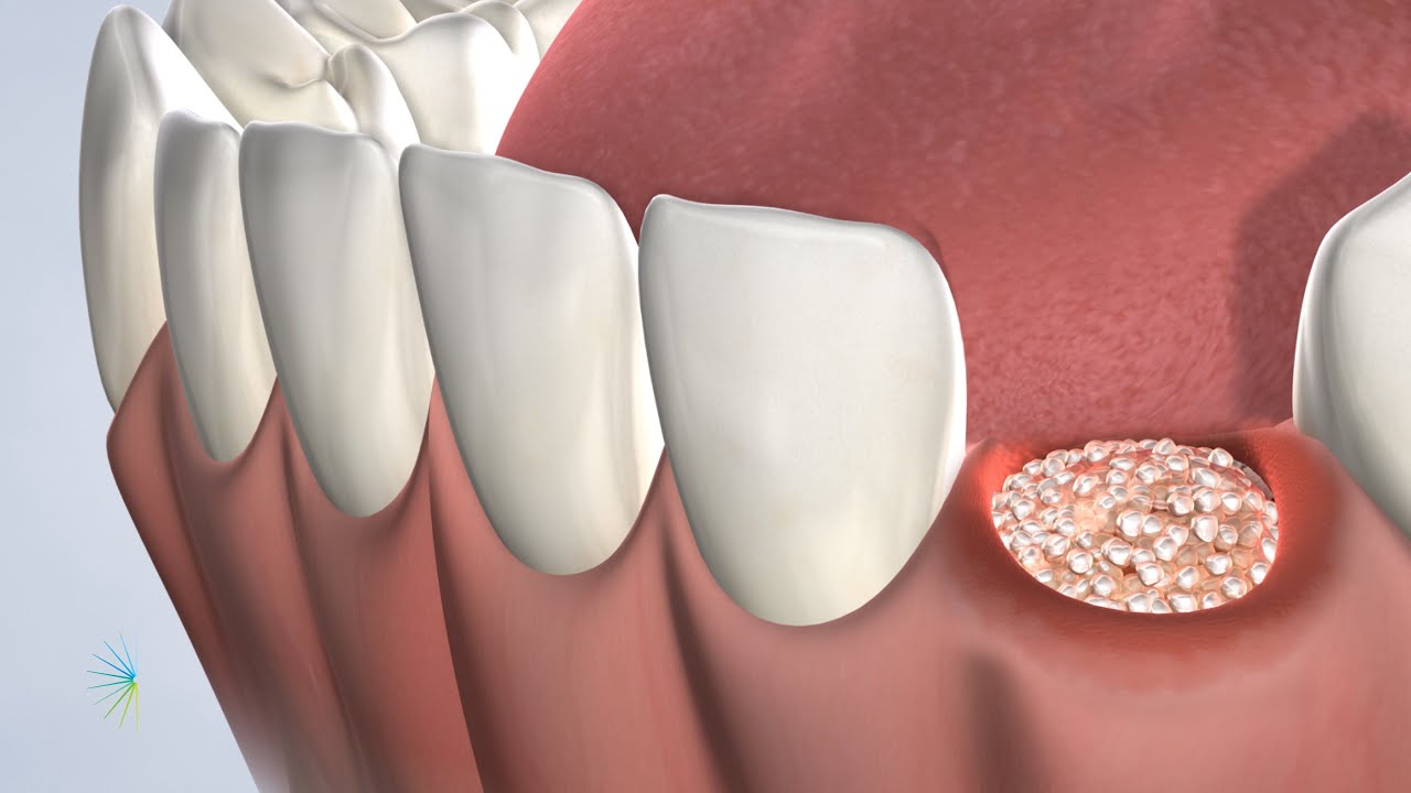 Socket Preservation in Oklahoma City, OK | Oral Surgery Specialists of Oklahoma