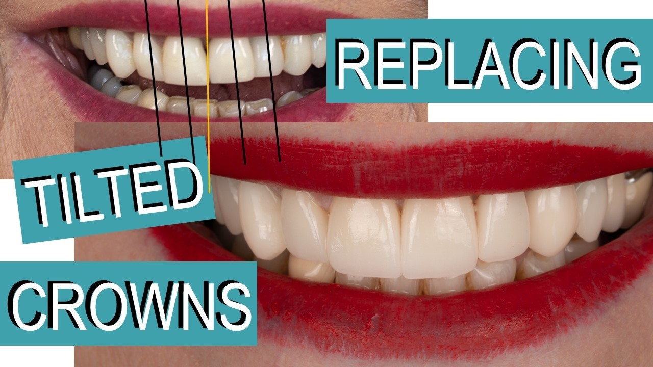 Замена четырех зубных коронок: пошаговый подход.